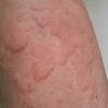 Urticaria